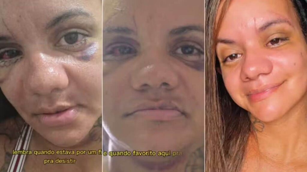 Mulher que foi agredida com 60 socos por ex-namorado mostra evolução da recuperação de cirurgia