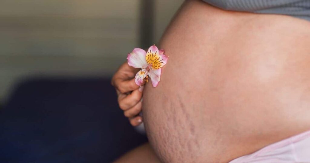 Varizes na gravidez? saiba as causas, sintomas e cuidados – Pais e Filhos